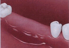 Puente sobre Implantes Dentales