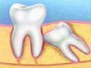 Puente sobre Implantes Dentales