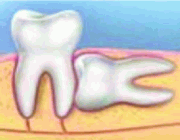 Puente sobre Implantes Dentales